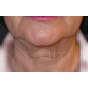 Antes y después del lifting en tercio inferior del rostro