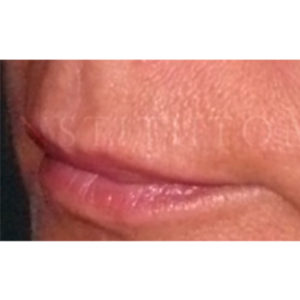 Lip Lift, antes y después