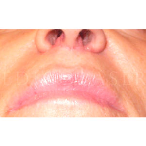Lip Lift para labio superior: fotos de antes y después