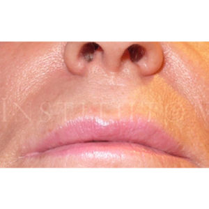 Lip Lift para labio superior: fotos de antes y después