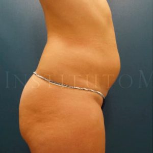 Lipohelio en abdomen, pre y post tratamiento