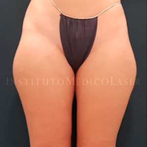 Lipo en cartucheras, antes y después