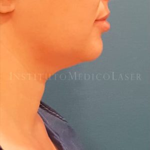 Lipohelio en papada, antes y después
