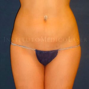Lipo Vaser y Renuvion en abdomen y trocánteres, antes y después