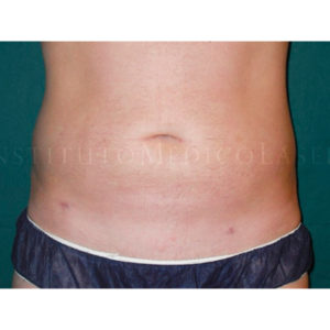 Lipoescultura de abdomen en hombres, antes y después
