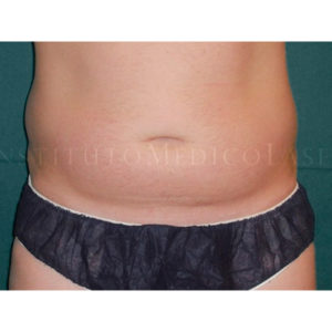 Lipoescultura de abdomen en hombres, antes y después