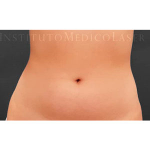 Lipohelio para reducir abdomen, antes y después del tratamiento