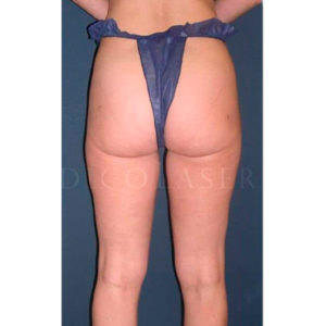 Antes y después de Laserlipólisis en cartucheras y piernas