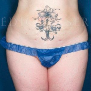 Lipoláser en abdomen con alta contracción de la piel