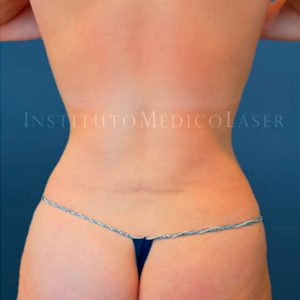 Liposucción de cintura, antes y después