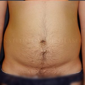 Liposucción hombres (Madrid)