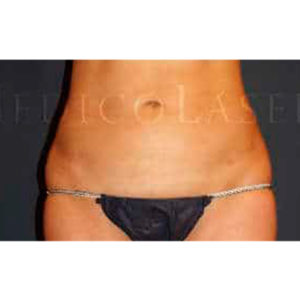 Reducción de abdomen y flancos con liposucción láser en Madrid