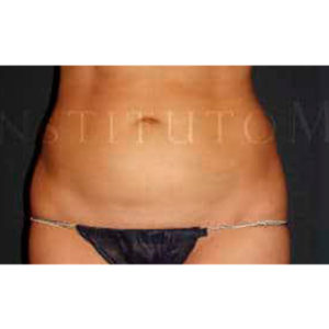 Reducción de abdomen y flancos con liposucción láser en Madrid