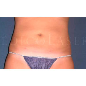 Liposucción por láser en el abdomen