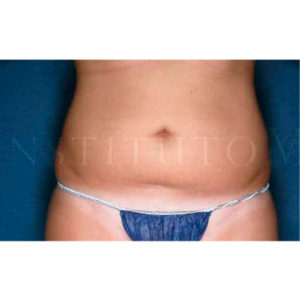 Liposucción por láser en el abdomen