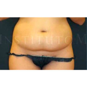 Antes
