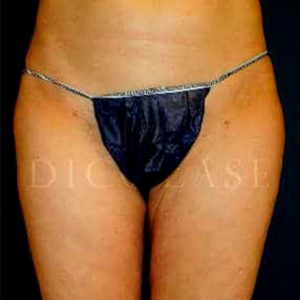 Antes y después de la liposucción láser en cartucheras y muslos en Instituto Médico Láser