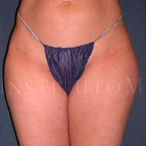 Antes y después de la liposucción láser en cartucheras y muslos en Instituto Médico Láser