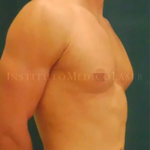 Liposucción Vaser en pectorales (Ginecomastia), antes y después