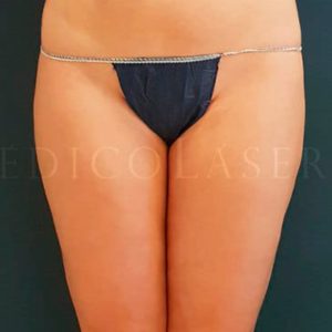 Lipo Vaser en cartucheras, antes y después