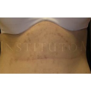 Manchas en abdomen, antes y después