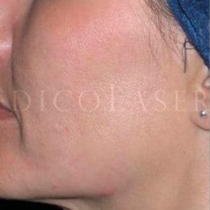 Antes y después del tratamiento para eliminar manchas en la cara (melasma)