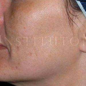 Antes y después del tratamiento para eliminar manchas en la cara (melasma)