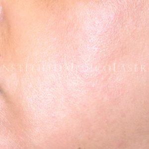 Melasma antes y después