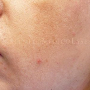 Melasma antes y después