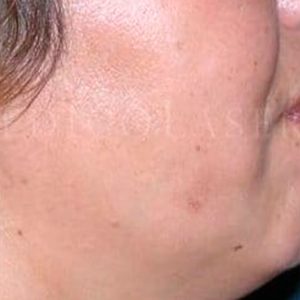 Melasma, fotografías del resultado del tratamiento en IML