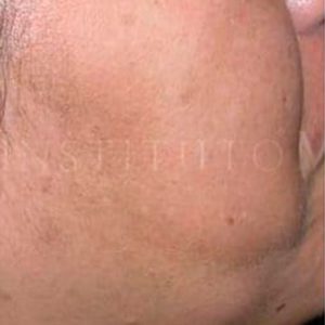 Melasma, fotografías del resultado del tratamiento en IML