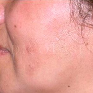Melasma facial, antes y después