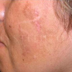 Melasma facial, antes y después