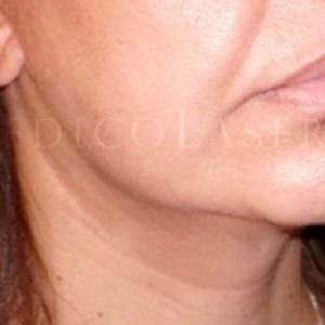 Antes y después del Mini Lifting facial