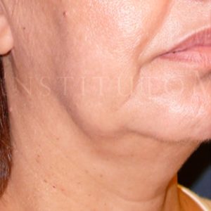 Antes y después del Mini Lifting facial