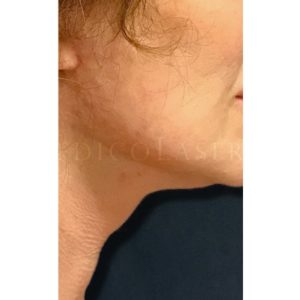 Antes y desués del Minilifting del tercio inferior facial