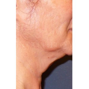 Antes y desués del Minilifting del tercio inferior facial