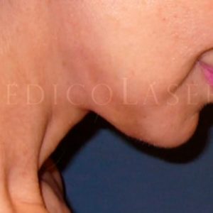 Pre y post Mini Lifting facial en Madrid