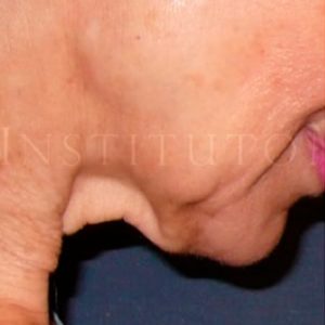 Pre y post Mini Lifting facial en Madrid