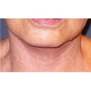Antes y después del minilifting en cuello y papada