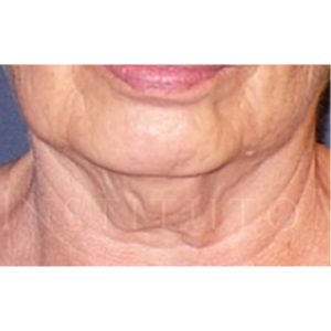 Antes y después del minilifting en cuello y papada