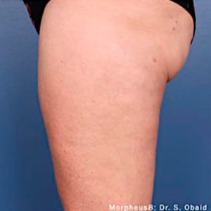 Celulitis en muslos, antes y después de Morpheus8