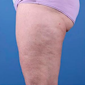 Celulitis en muslos, antes y después de Morpheus8