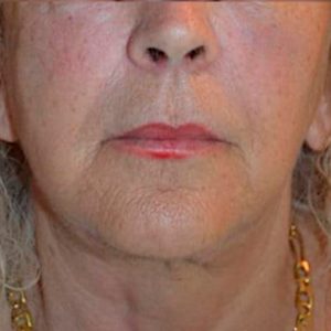 Fotos antes y después de flacidez en cara y cuello