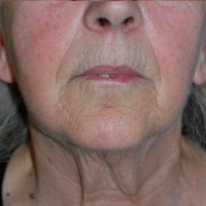 Fotos antes y después de flacidez en cara y cuello