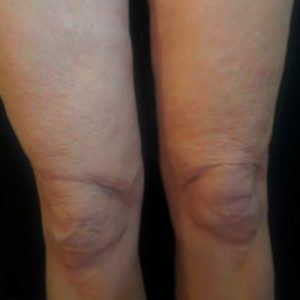 Celulitis y flacidez con Morpheus, antes y después
