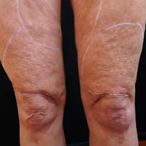 Celulitis y flacidez con Morpheus, antes y después