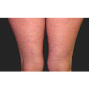 Tratamiento con ondas de choque contra la celulitis