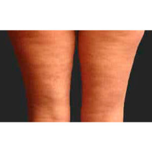 Tratamiento con ondas de choque contra la celulitis
