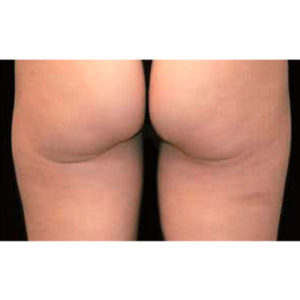 Tratamiento de la celulitis en glúteos, antes y después